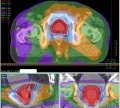 前立腺癌の体幹部定位照射