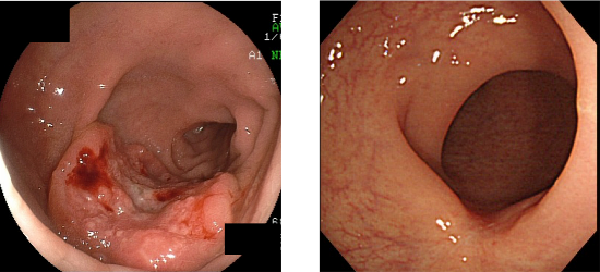 Figure 1: Before and after chemoradiotherapy (CRT)