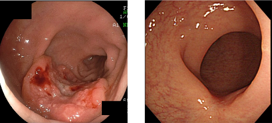 Figure 1: Before and after chemoradiotherapy (CRT) Figure 1: Before and after chemoradiotherapy (CRT)