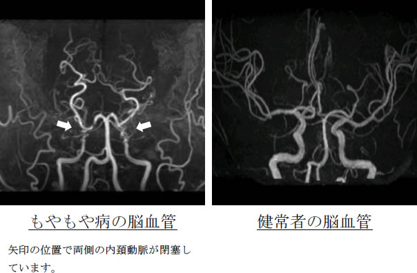 　もやもや病の脳血管 矢印の位置で両側の内頚動脈が閉塞しています。 健常者の脳血管