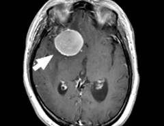 東京大学医学部脳神経外科：頭蓋底髄膜腫