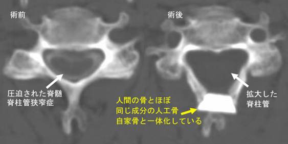 脊柱管狭窄症 症状 原因