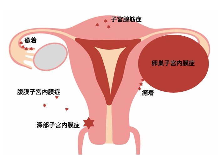 子宮内膜症外来｜東京大学医学部附属病院