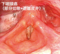 機能温存を重視した咽頭癌・喉頭癌治療