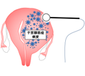 子宮腺筋症核出術