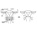 広汎子宮頸部摘出術