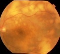 眼内悪性リンパ腫の脳播種予防を目的とした治療