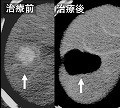 肝悪性腫瘍に対する経皮的局所療法（RFA）