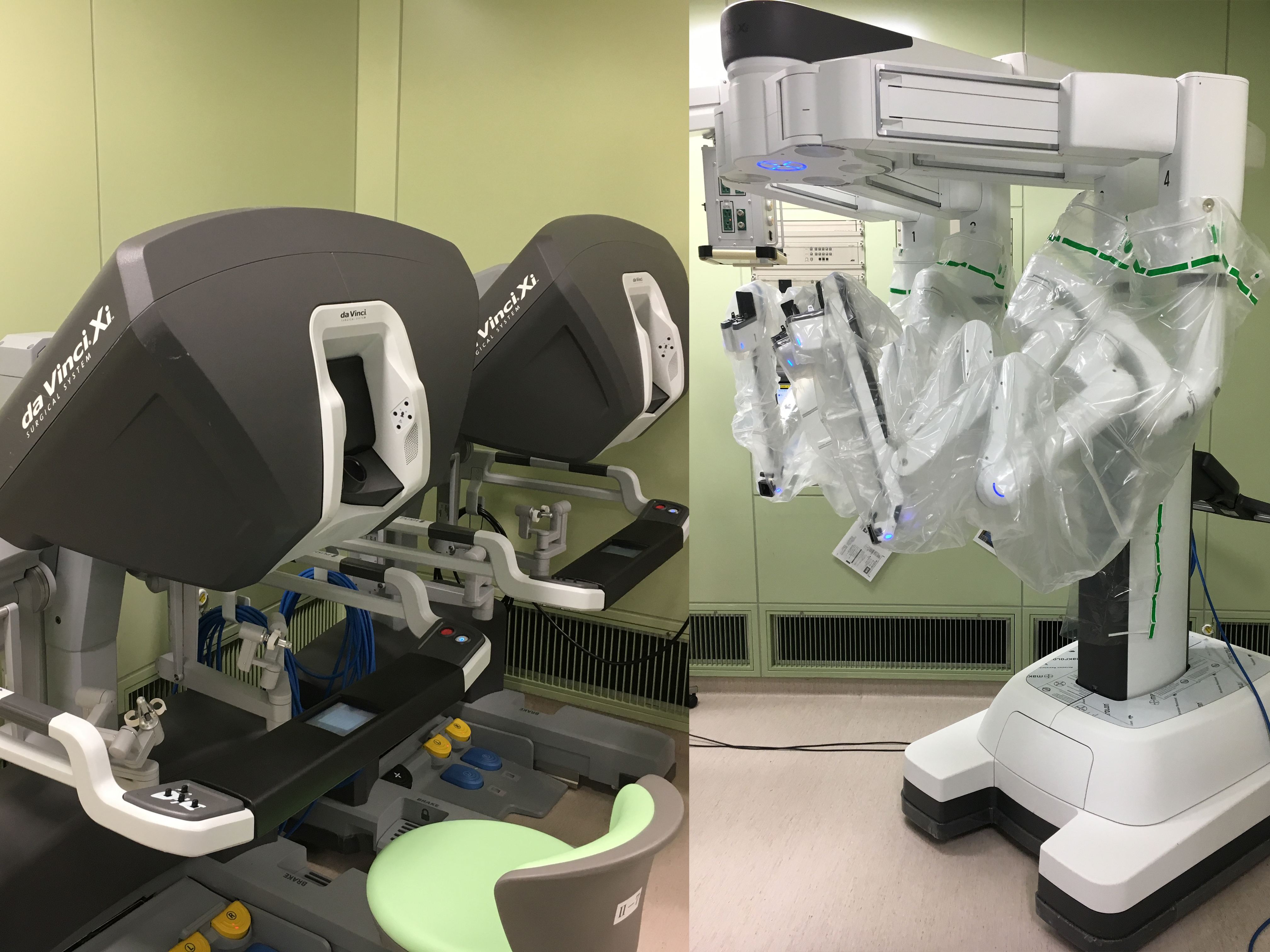 直腸がんに対するロボット手術