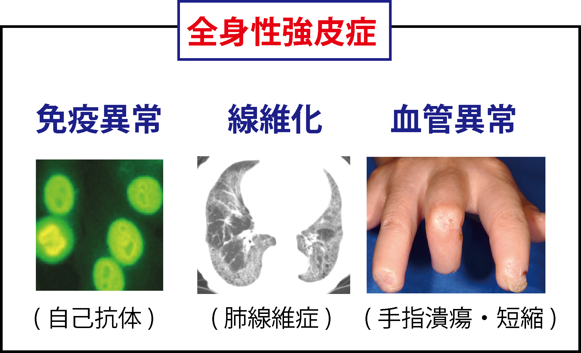 強皮症センターの設立と新規治療への取り組み