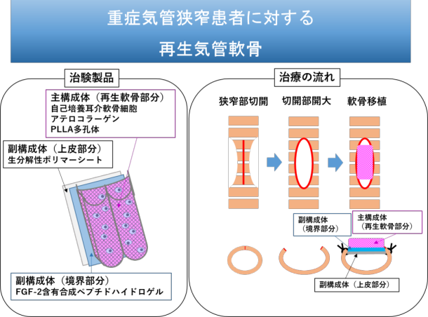 重症気管狭窄患者に対する再生気管軟骨