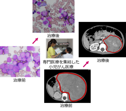 小児がん診療