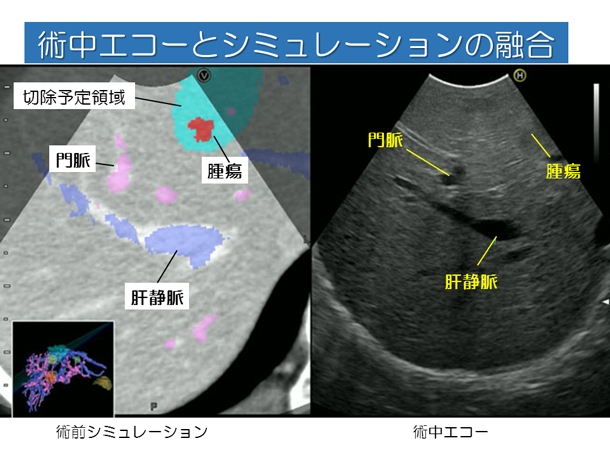 術中エコーとしシミュレーションの融合