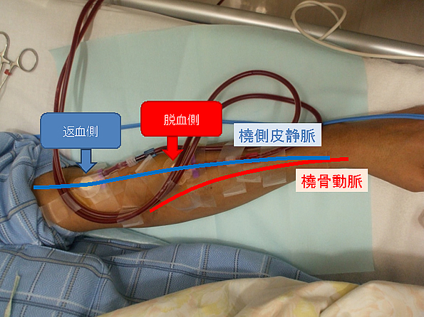 血液透析導入の患者様